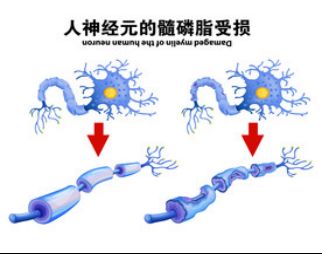 “神秘”多發(fā)性硬化癥，其實沒那么可怕！