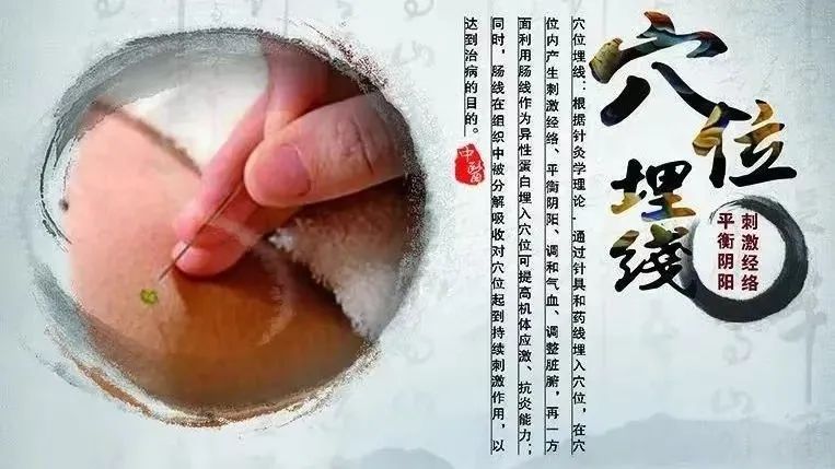 埋線新科技，輕松享“瘦”